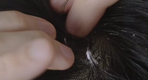 로게인폼 사용법