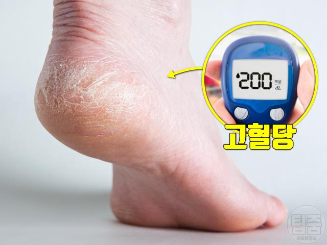 발뒤꿈치 갑상샘 당뇨병