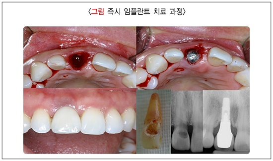 임플란트 의료보험적용 총정리