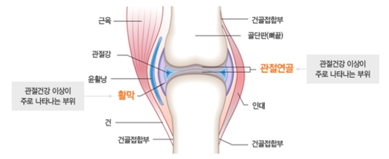허벅지 근육과 무릎 연골 건강의 상관관계 관련 이미지