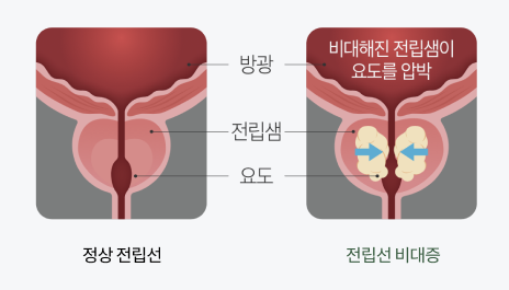 카리토포텐 전립선 비대증