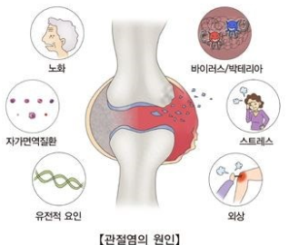 류마티스 관절염의 초기 증상 관련 이미지
