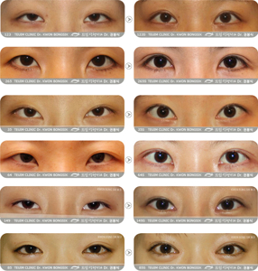 남자 눈매 교정술