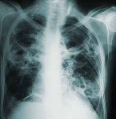 만성폐쇄성 폐질환 진단법 치료 합병증 관리
