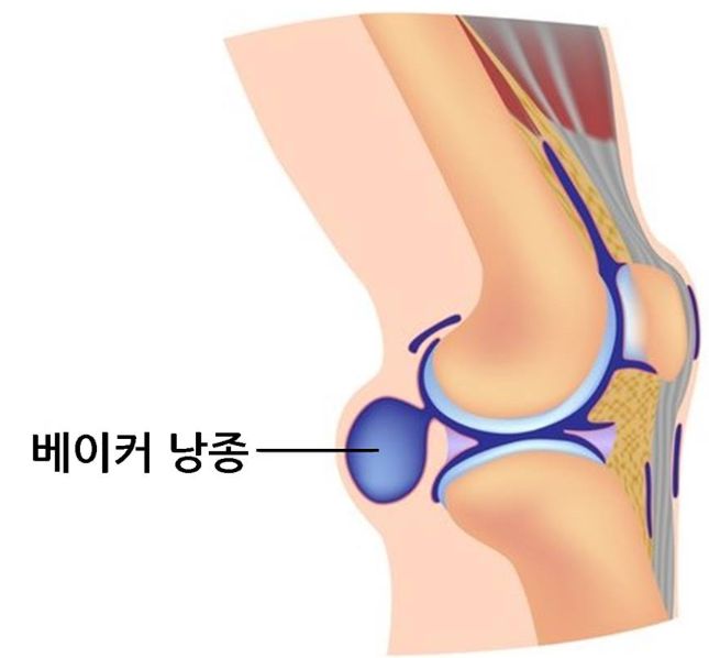 베이커낭종