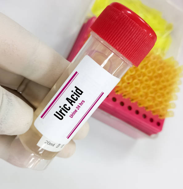 통풍 요산 정상수치란