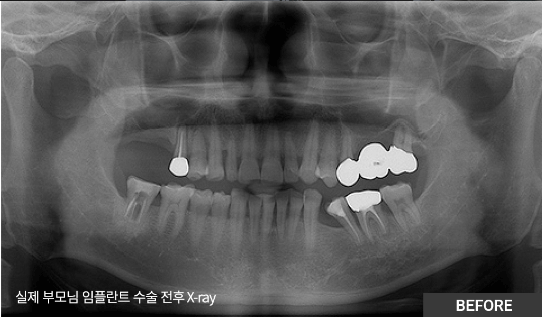 강남플란치과-임플란트가격-비용-시술후기-이벤트