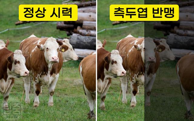뇌종양 증상 시력 반맹