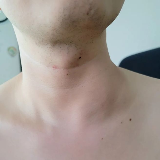 림프절 위치