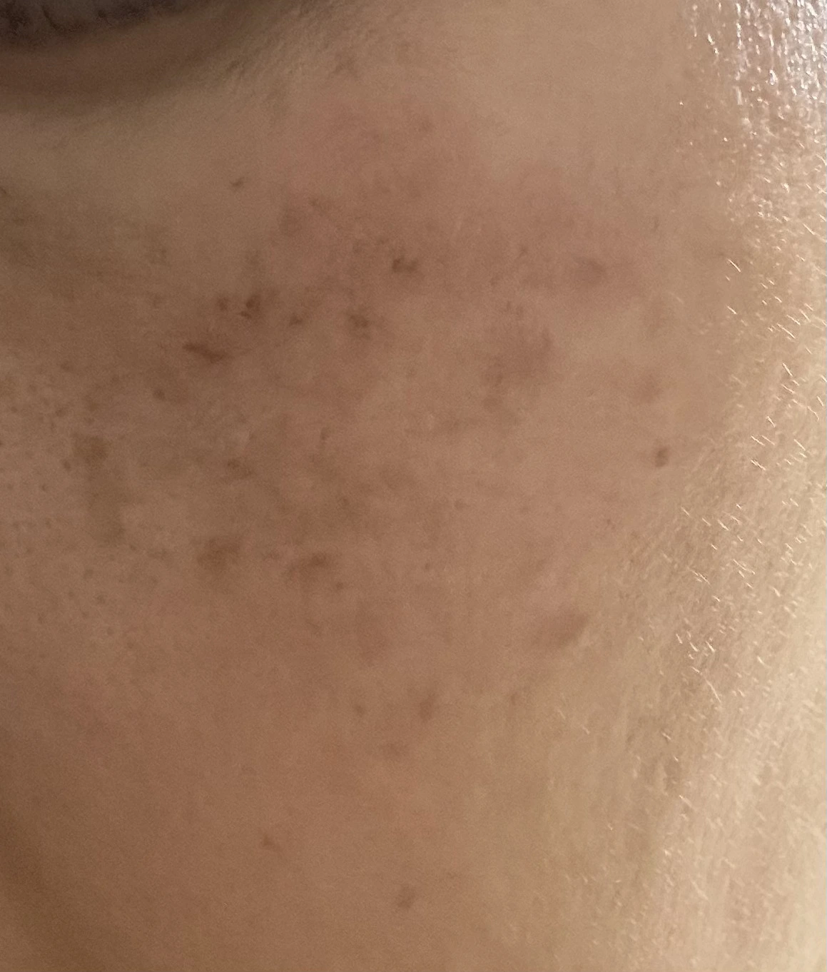 얼굴 기미 잡티 제거 멜라논 크림 2개월 사용 후기