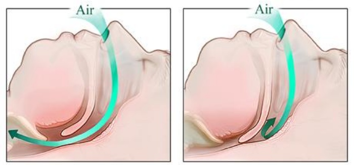 수면무호흡증 원인 설명