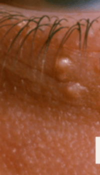 눈밑에 하얀 좁쌀