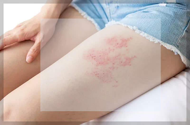 다리 수두 대상 포진 바이러스