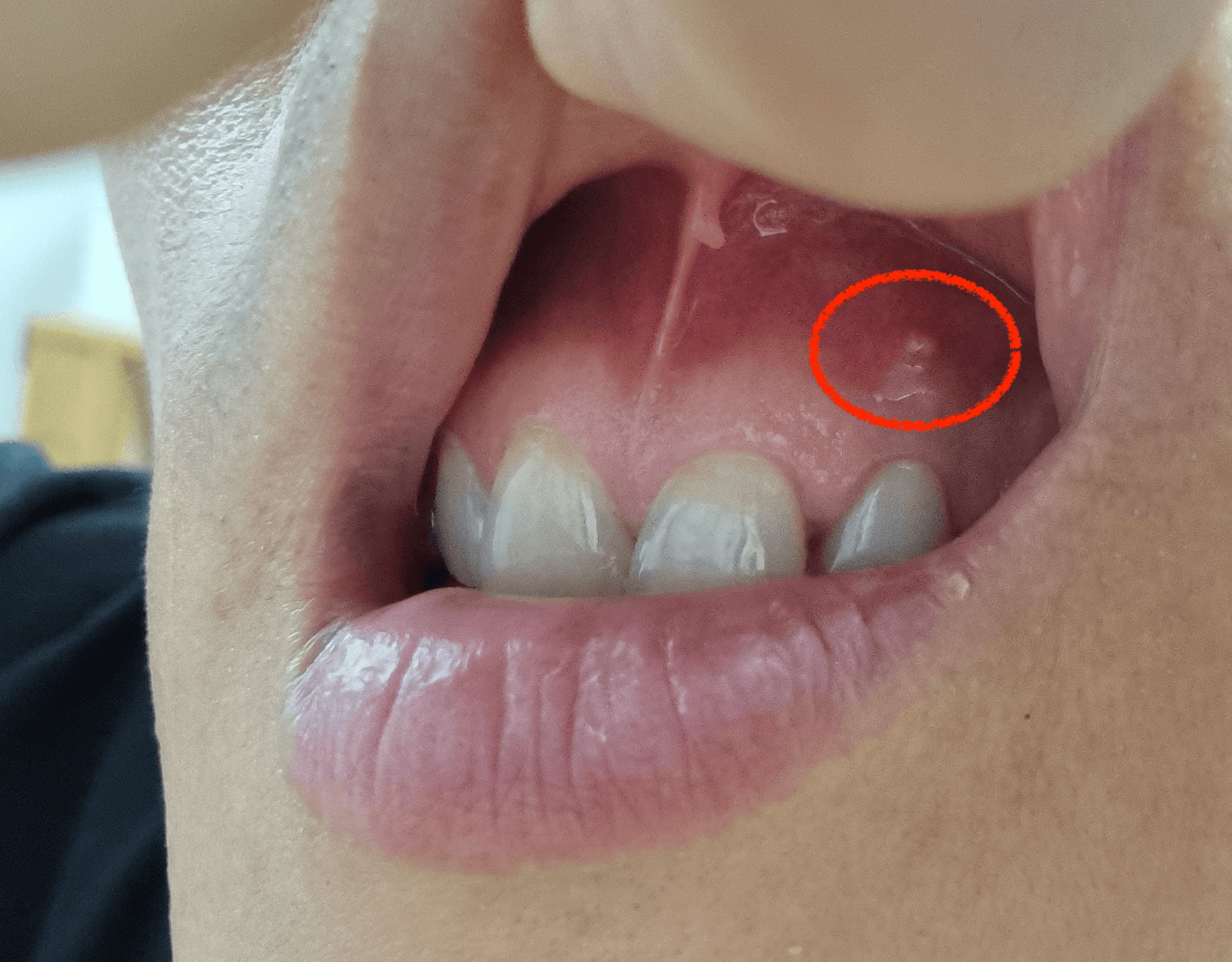 잇몸 염증 재발