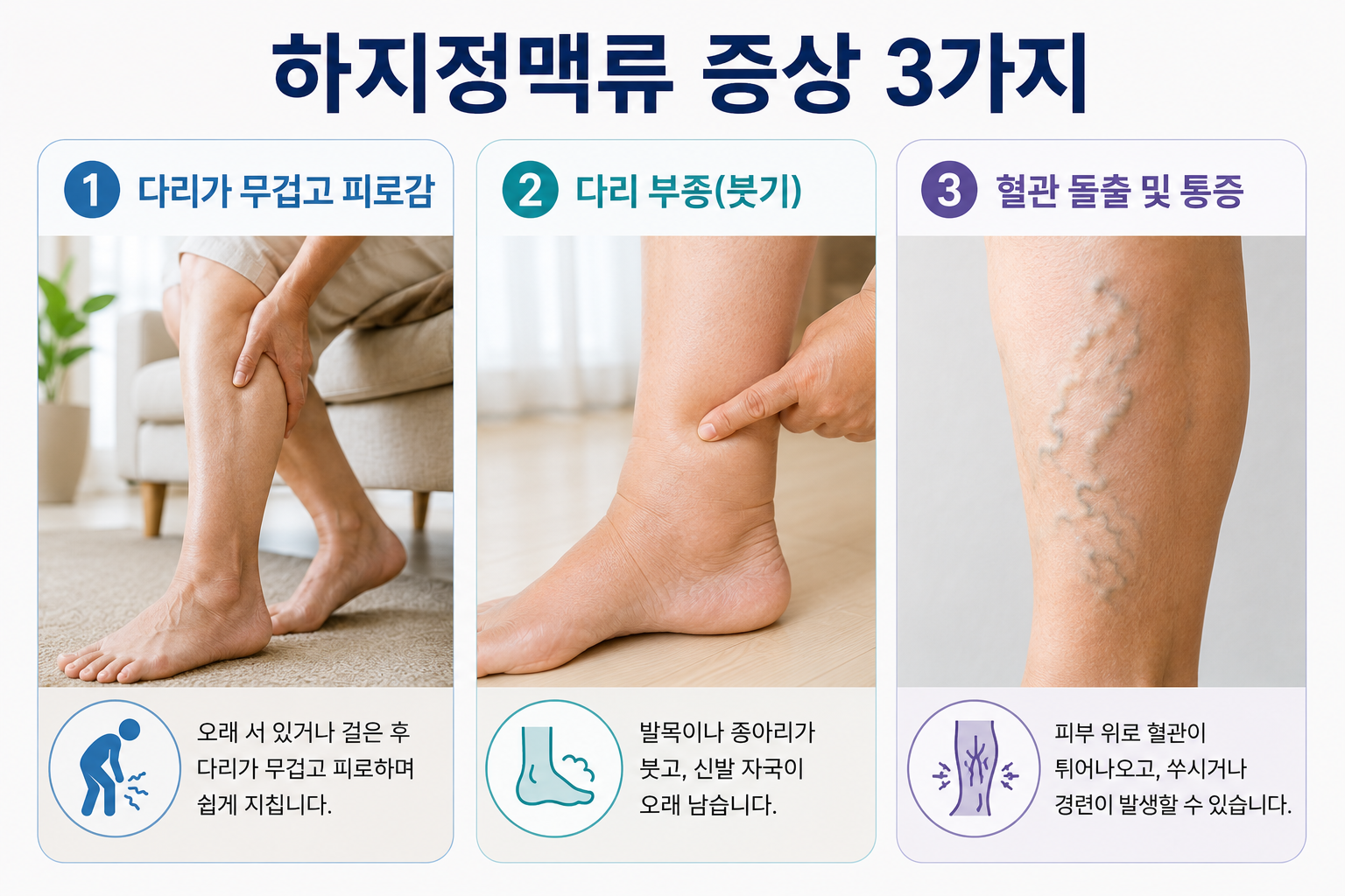 하지정맥류 원인, 증상, 치료까지