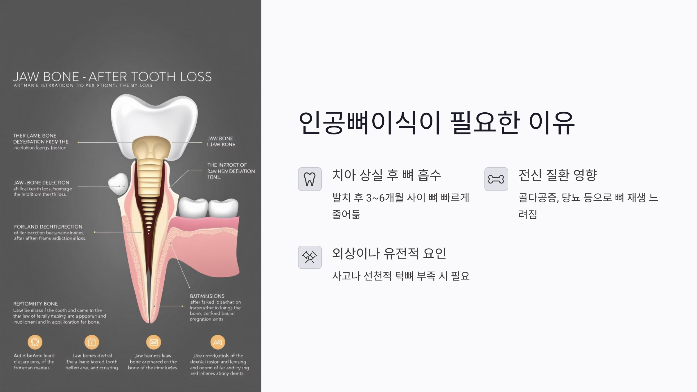 임플란트 전에 꼭 알아야 할 인공뼈이식 가이드: 비용부터 회복까지