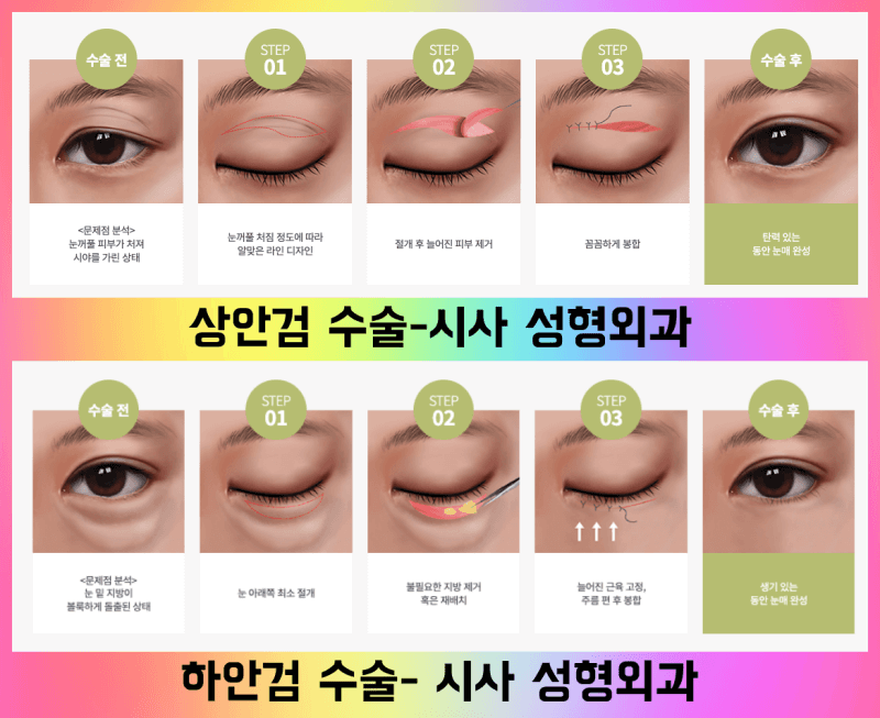 상안검 하안검 수술 방법 순서