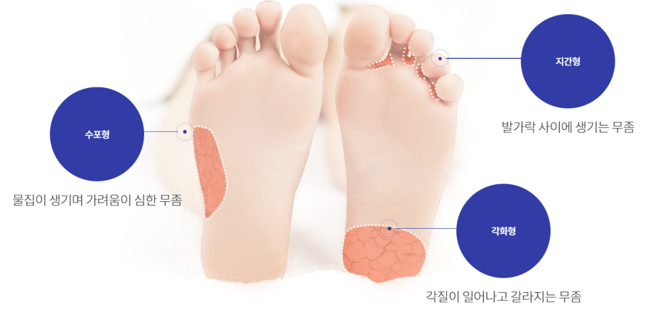 수포형 무좀과 지간형 무좀, 각화형 무좀의 자주 생기는 위치