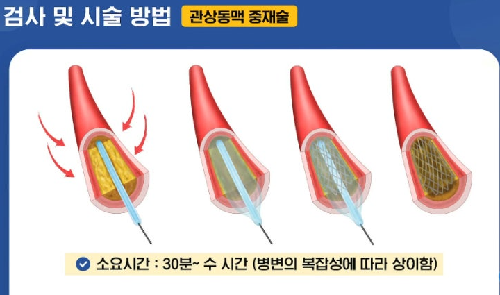 협심증-심근경색-차이-관상동맥-중재술-명의