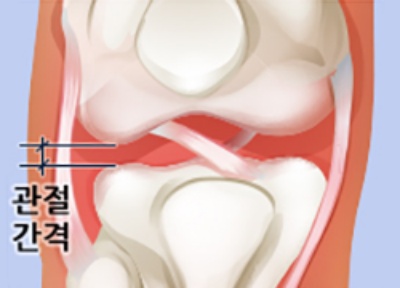 무릎관절염-정상