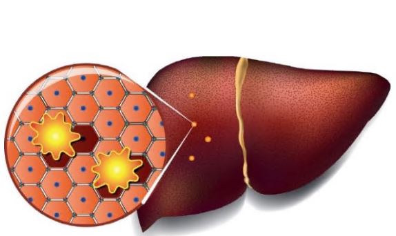 알부민-부작용-수치-건강-신호