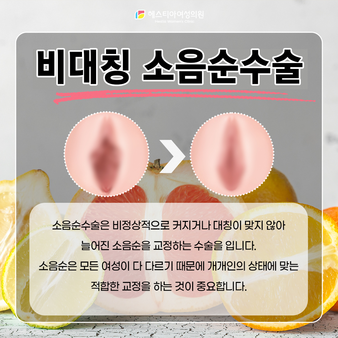 비대칭 소음순수술