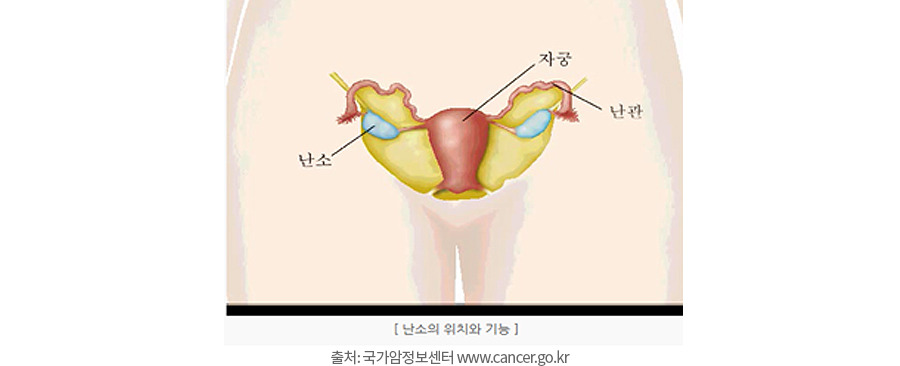 난소암 증상, 원인, 치료- ‘침묵의 암’이라 불리는 이유와 예방법