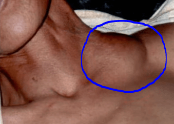 흑사병으로 인한 림프 부종