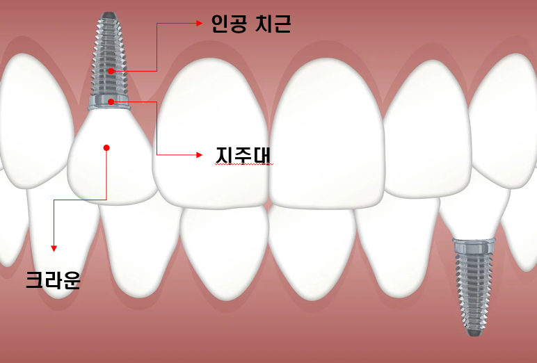임플란트 크라운 이미지