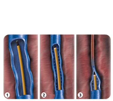 다리가-붓는-이유-하지정맥류-수술비용