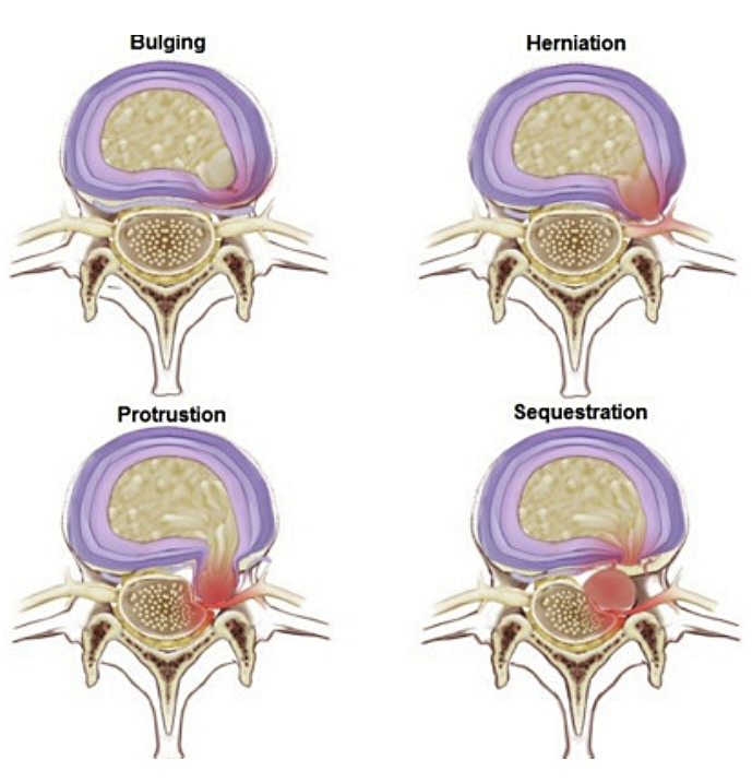 허리디스크 터지면 나타나는 증상과 실용적인 치료 전략들