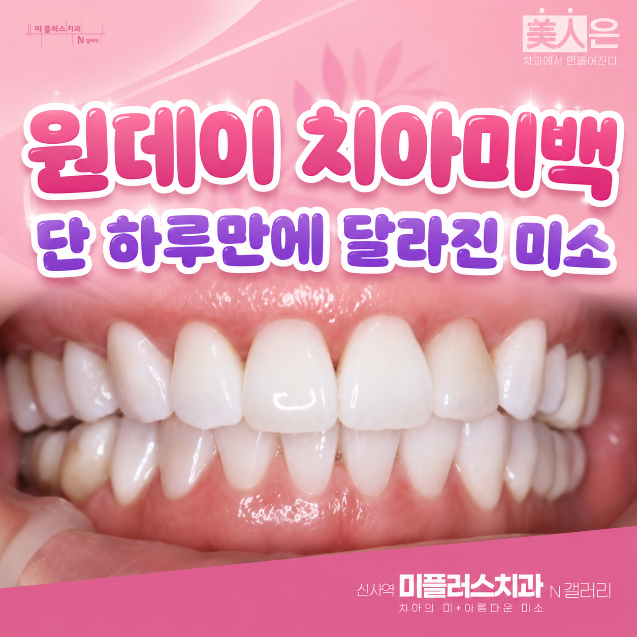 데이 치아미백 후 밝아진 치아와 환한 미소를 보여주는 치아미백 결과 이미지