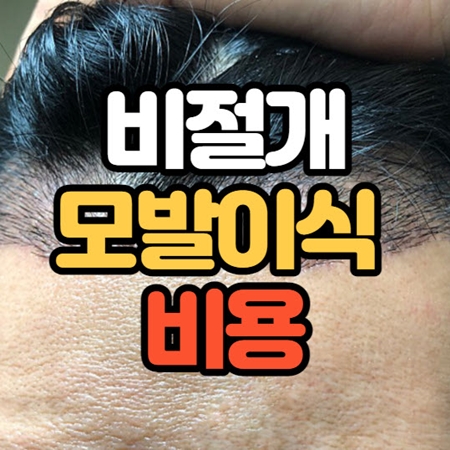 비절개 모발이식 가격