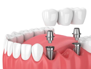 만 65세 이상 임플란트