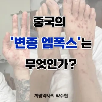엠폭스 증상 예방접종 대처법 치료방법_5