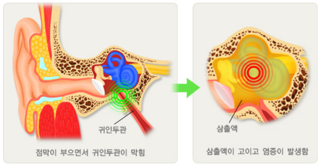 중이염 증상 치료방법
