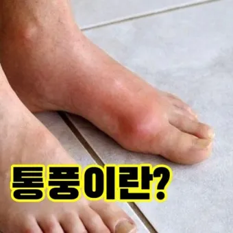 발가락 통풍 증상 및 대처방법_13