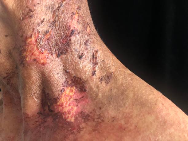 피부염 증상 두경부 유방암 얼굴 원인 암 방사선 치료 부작용 가려움 의 후유증 과정 피폭 피폭량 치료법