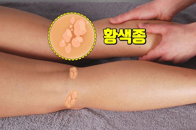 콜레스테롤 수치 높으면 혈관 생로병사의 비밀 황색종