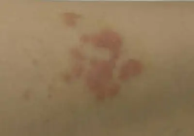 대상포진-예방접종-무료-가격-종류-건강