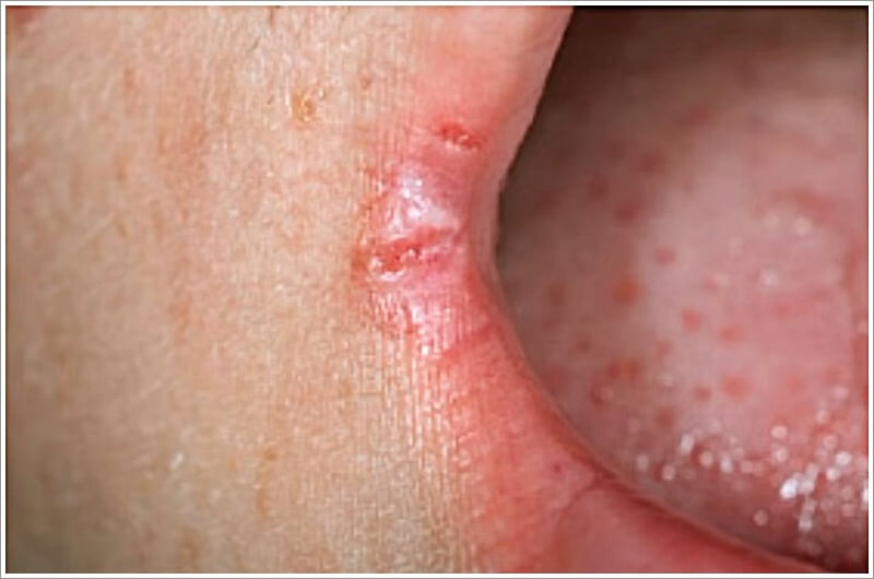 구각염-입술옆 찢어짐