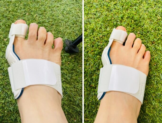 무지외반증 교정기 야간교정기