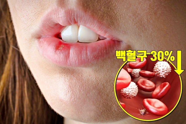 심한 스트레스 증상, 입병, 구내염, 구순염, 백혈구 수치,건강 팁줌 매일꿀정보