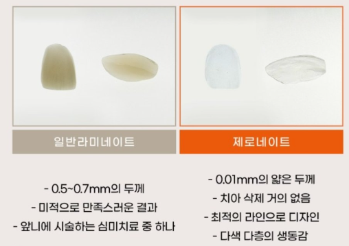 제로네이트 가격 비용 부작용 뜻 후기 라미네이트 차이점
