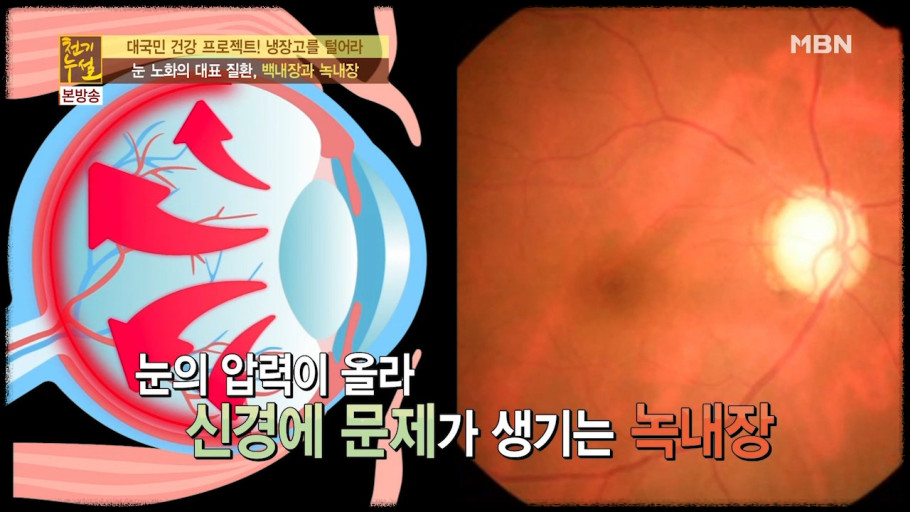 눈 건강&amp;#44; 조기 진단의 열쇠