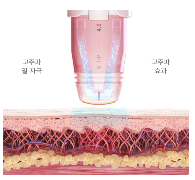 볼뉴머 효과
