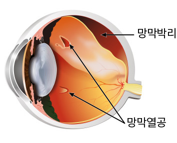 망막박리