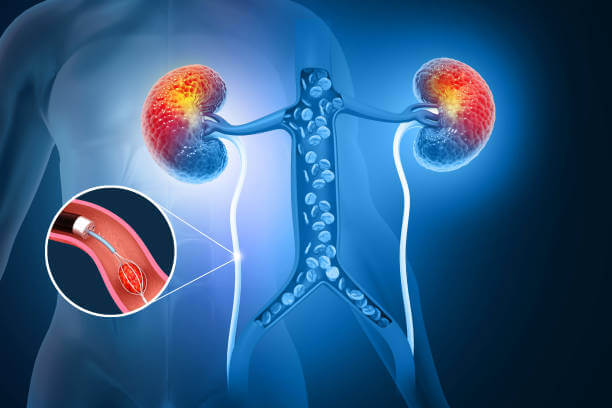 콩팥이 안 좋으면 나타나는 증상들이 있습니다. 콩팥은 간과 마찬가지로 침묵하는 장기이기 때문에 악화되어도 알아차리지 못하는 경우가 많기 때문에 주의가 필요합니다. 신장 건강에 문제가 생기면 여러 질병이 생길 수 있어 이러한 부분들을 잘 관리해야 합니다.