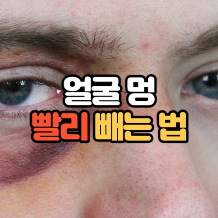 얼굴 멍 빨리 빼는법