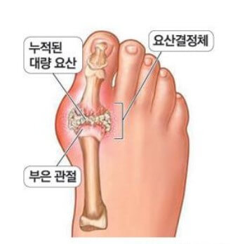 통풍의 원인과 발생 부위